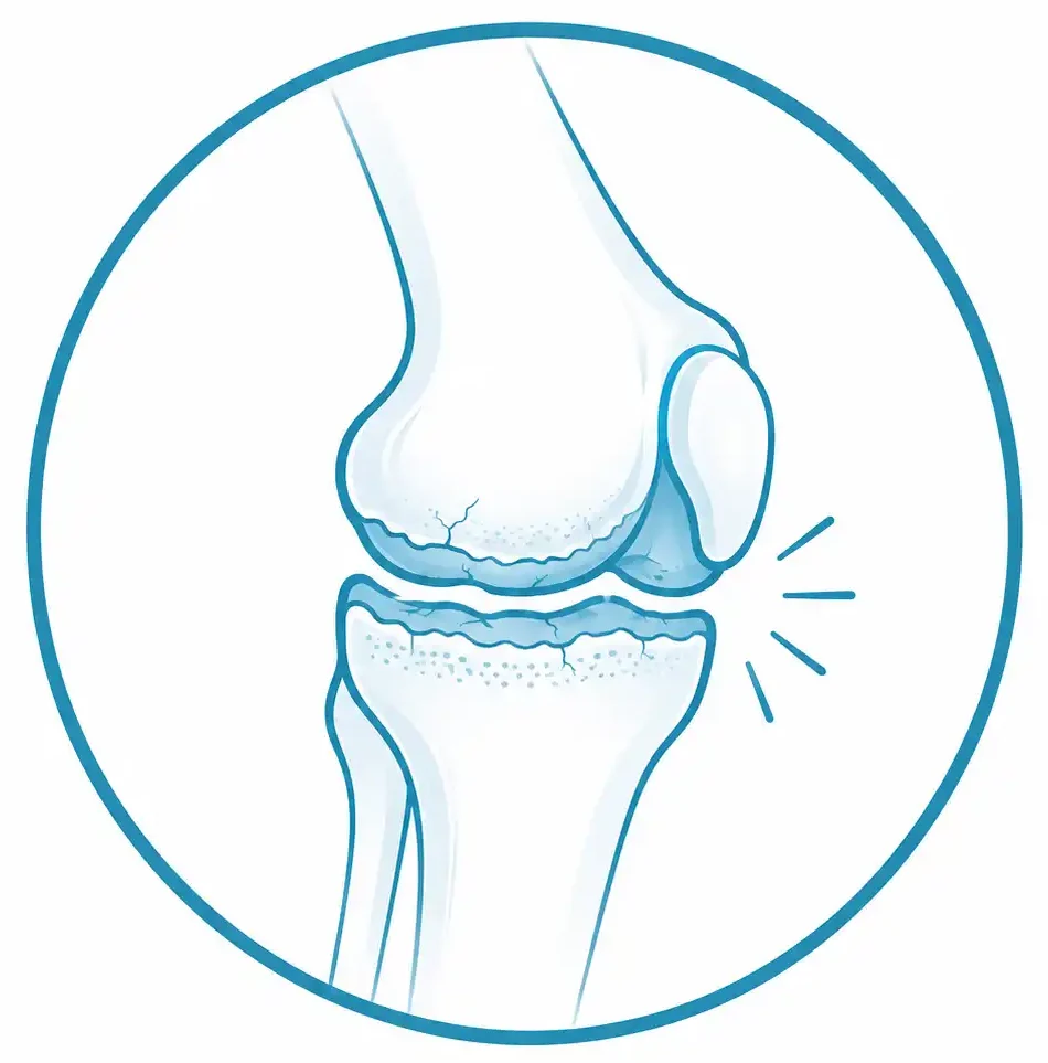Artrosis de rodilla en traumatología