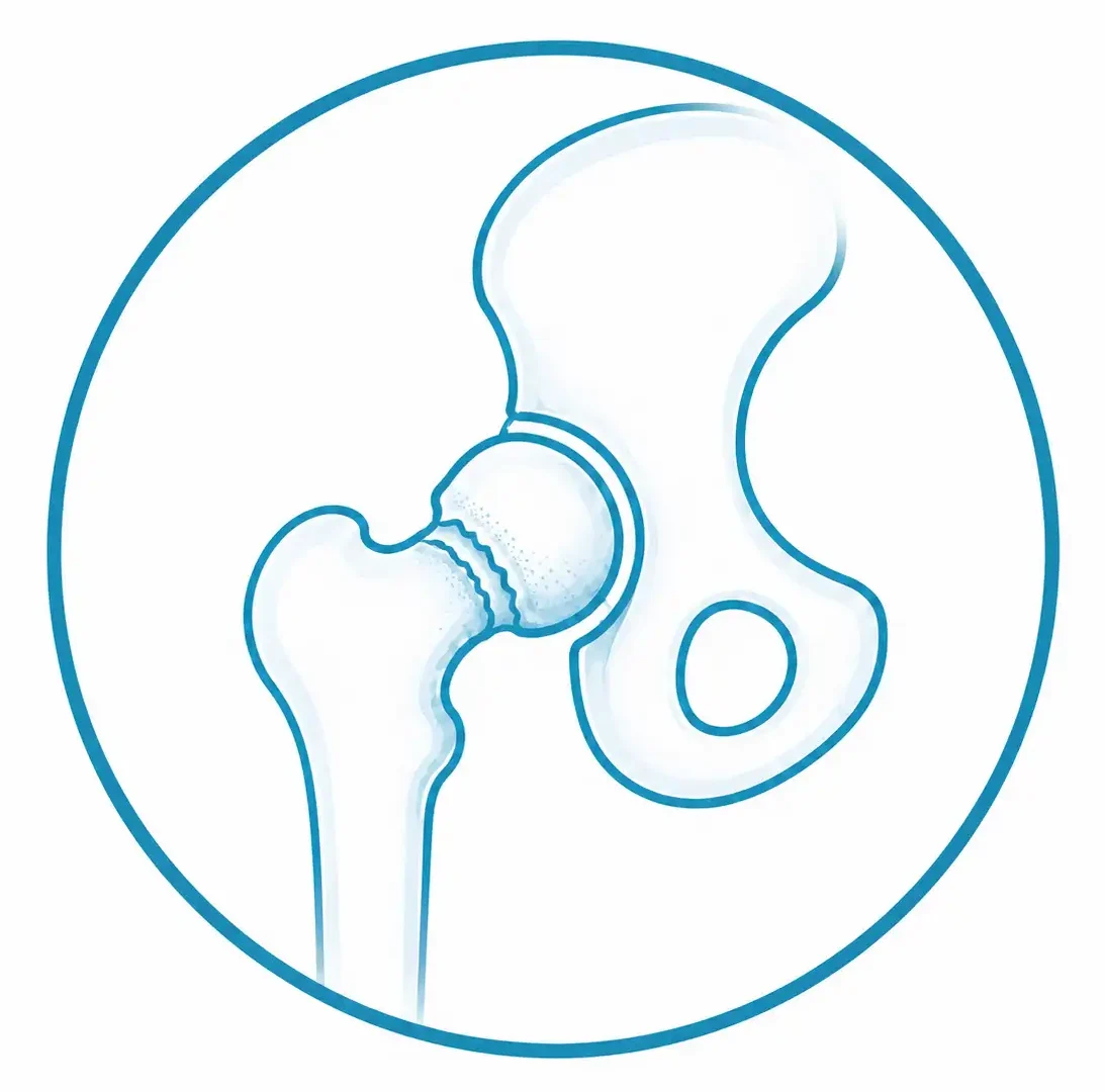 Artrosis de cadera en traumatología