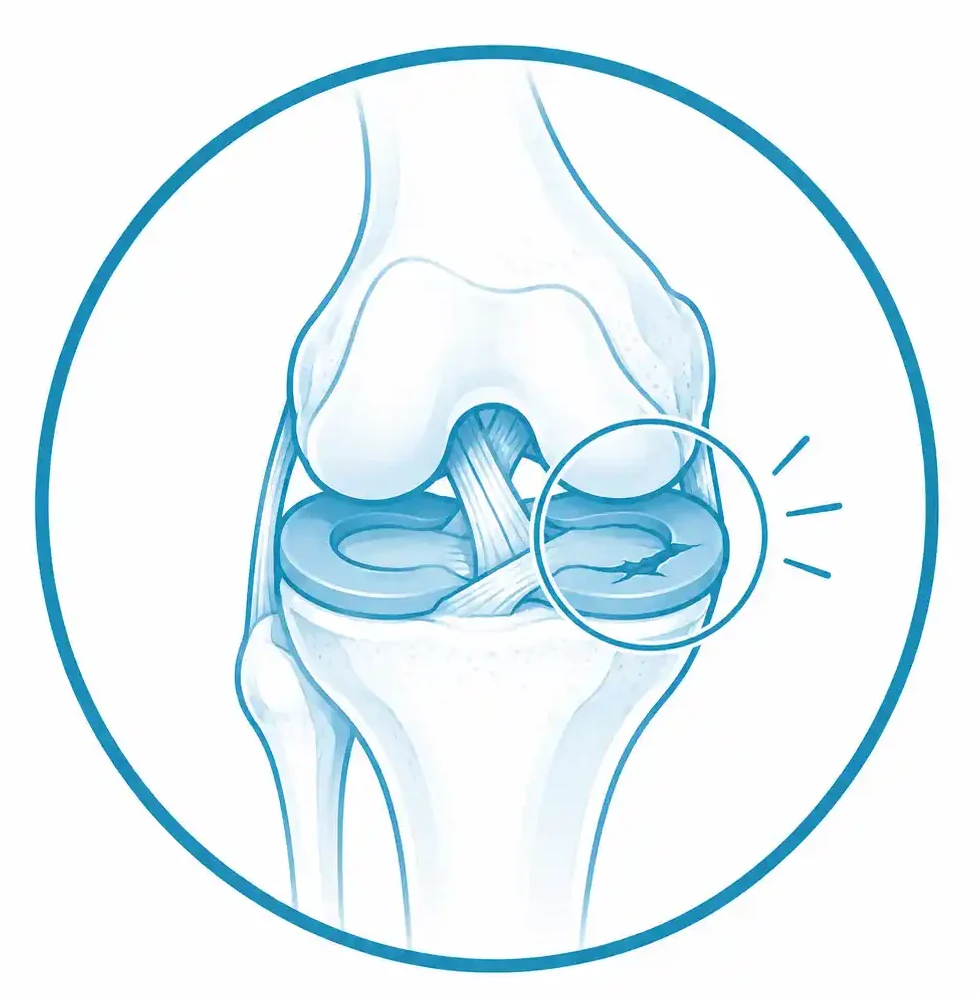 Lesiones de menisco en traumatología