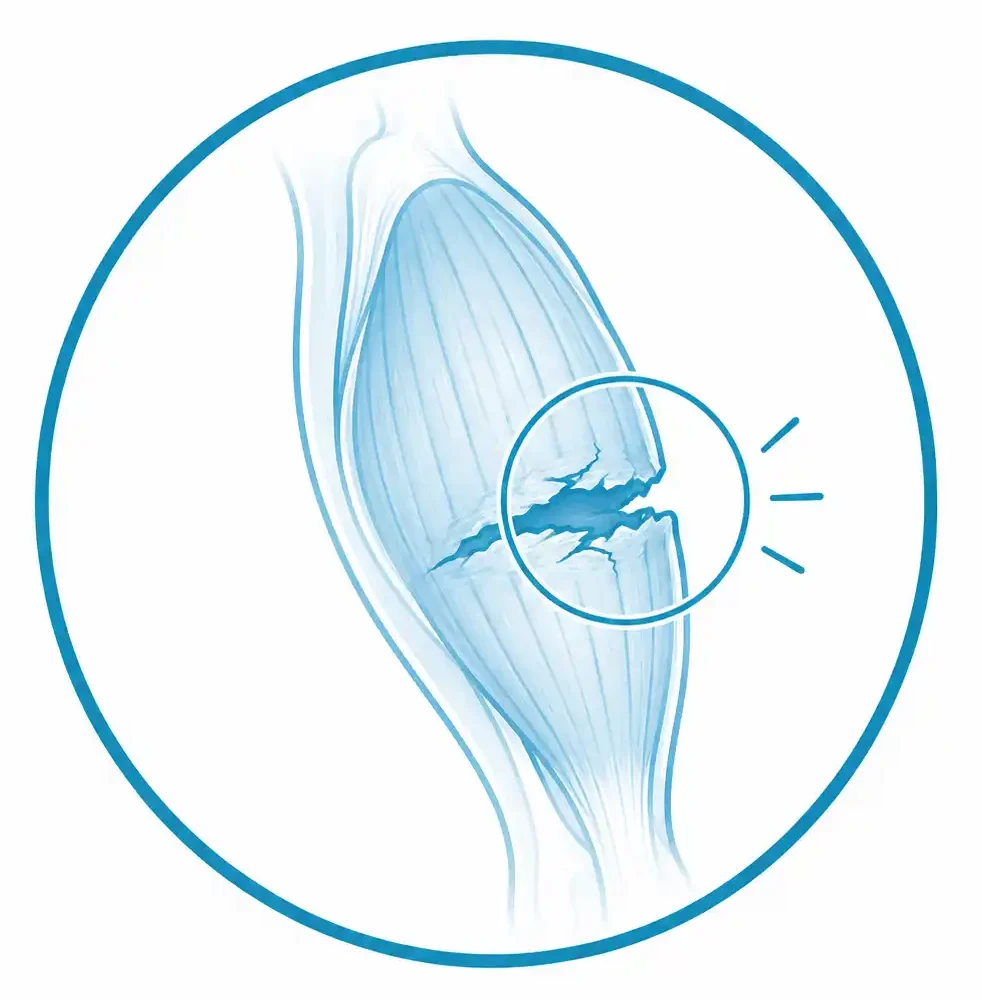 Roturas musculares en Palma de Mallorca tratadas en Global Clinics