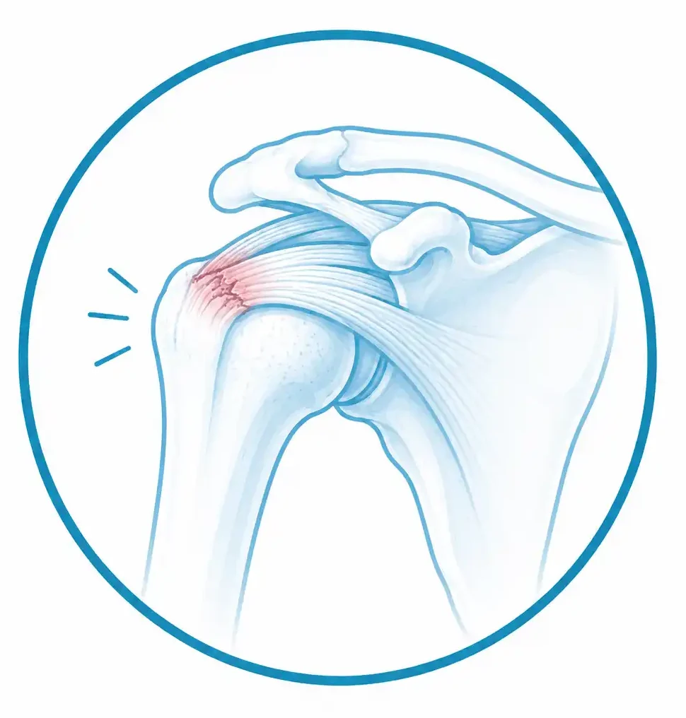 Tendinopatías del hombro y manguito rotador en traumatología