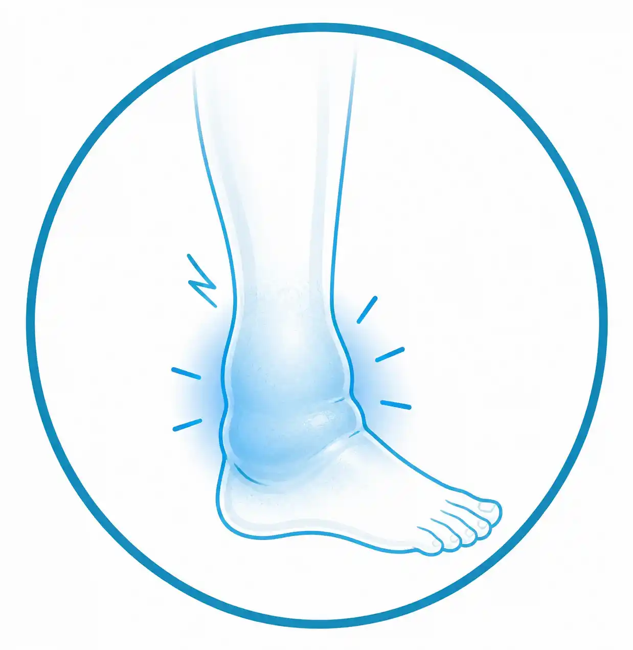 "Ilustración médica de edema e inflamación del tobillo tras una lesión."