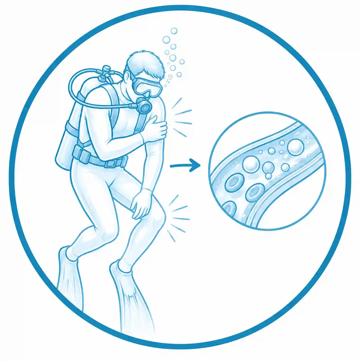 Ilustración de enfermedad descompresiva por buceo tratada con cámara hiperbárica para favorecer la eliminación de burbujas de gas y la recuperación.