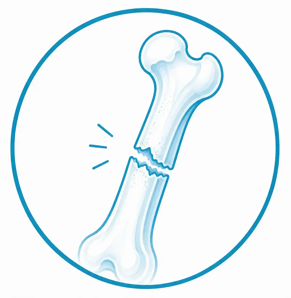 Ilustración médica de una fractura ósea en un hueso largo con una rotura visible, representando una lesión ósea.