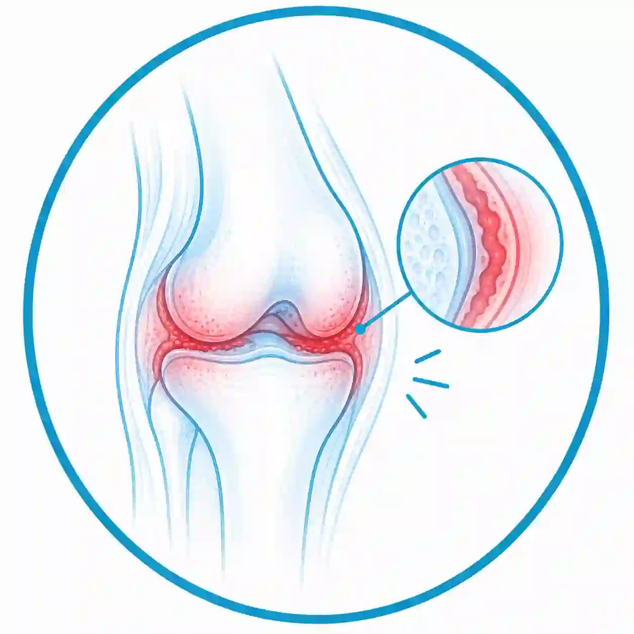 Ilustración médica de inflamación articular crónica y afectación de una articulación.