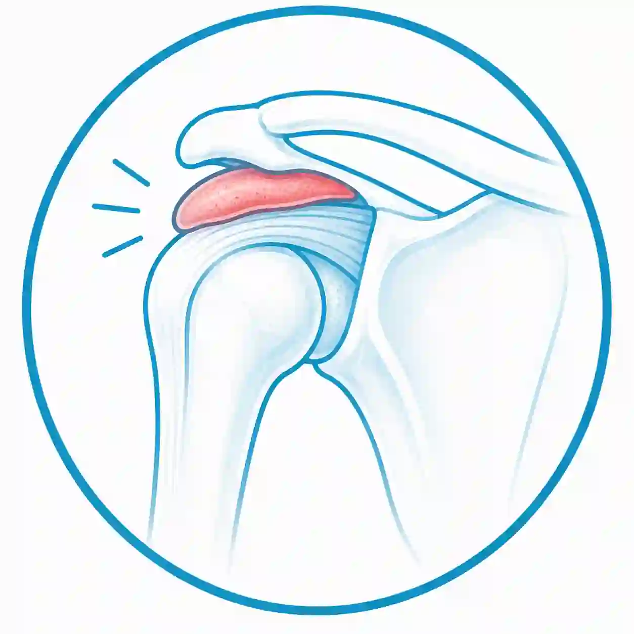 Ilustración médica de bursitis crónica en el hombro para explicar tratamientos en una clínica regenerativa especializada.