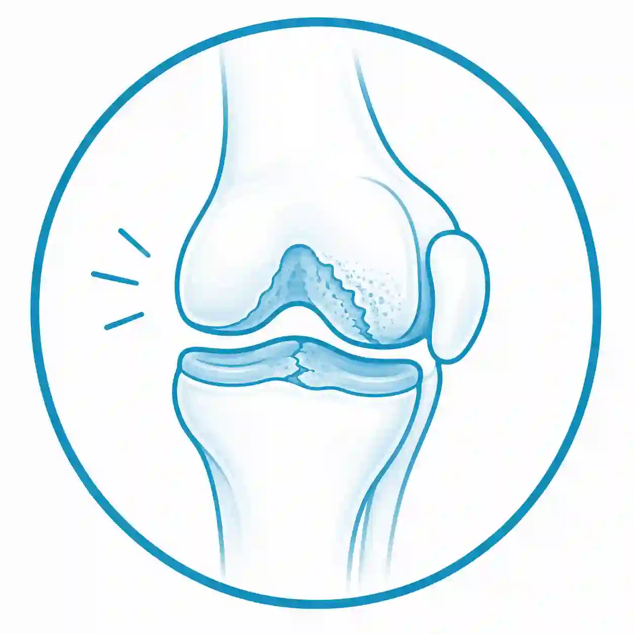 Ilustración de lesión del cartílago tratada con medicina regenerativa en Mallorca para favorecer la recuperación articular.