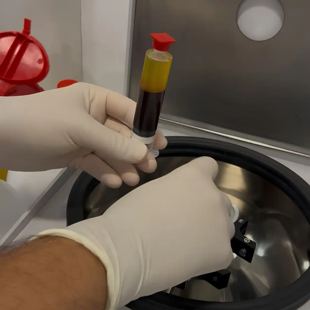 Preparación de Plasma Rico en Plaquetas PRP para tratamiento regenerativo